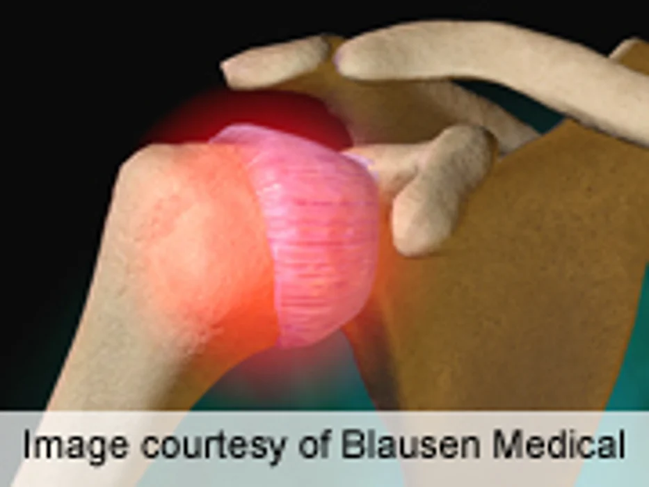 PCPs Can Use U/S to Rationalize Tx in Acute Shoulder Pain