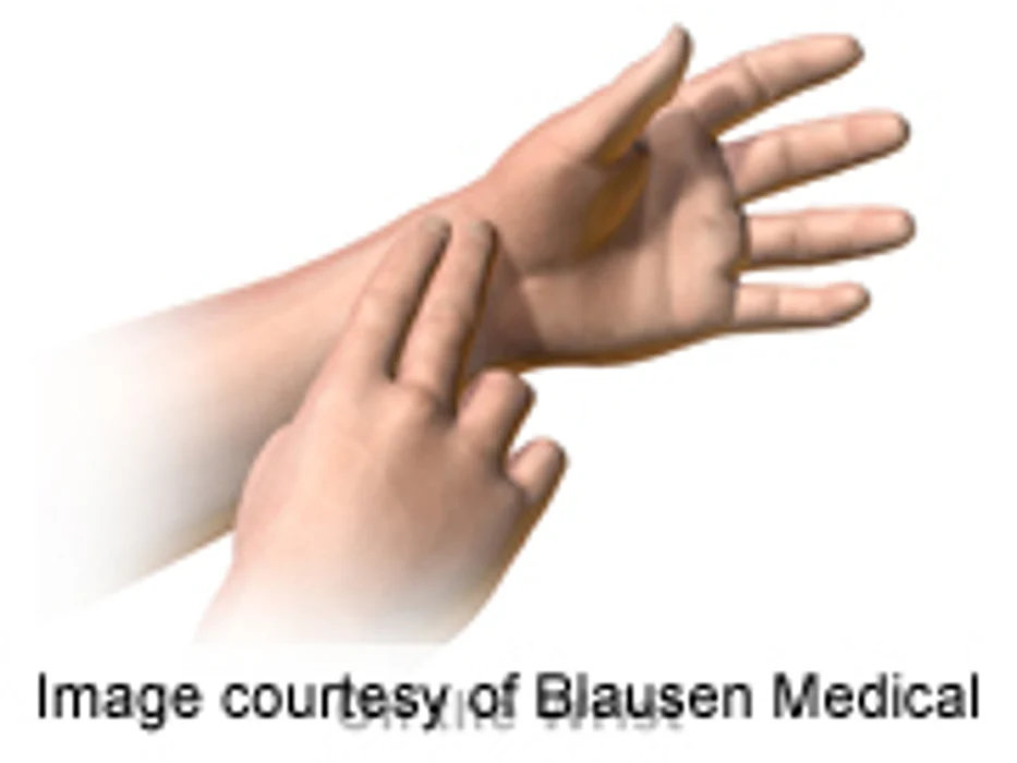 Routine Pulse Check May Prevent Second Stroke, Study Says