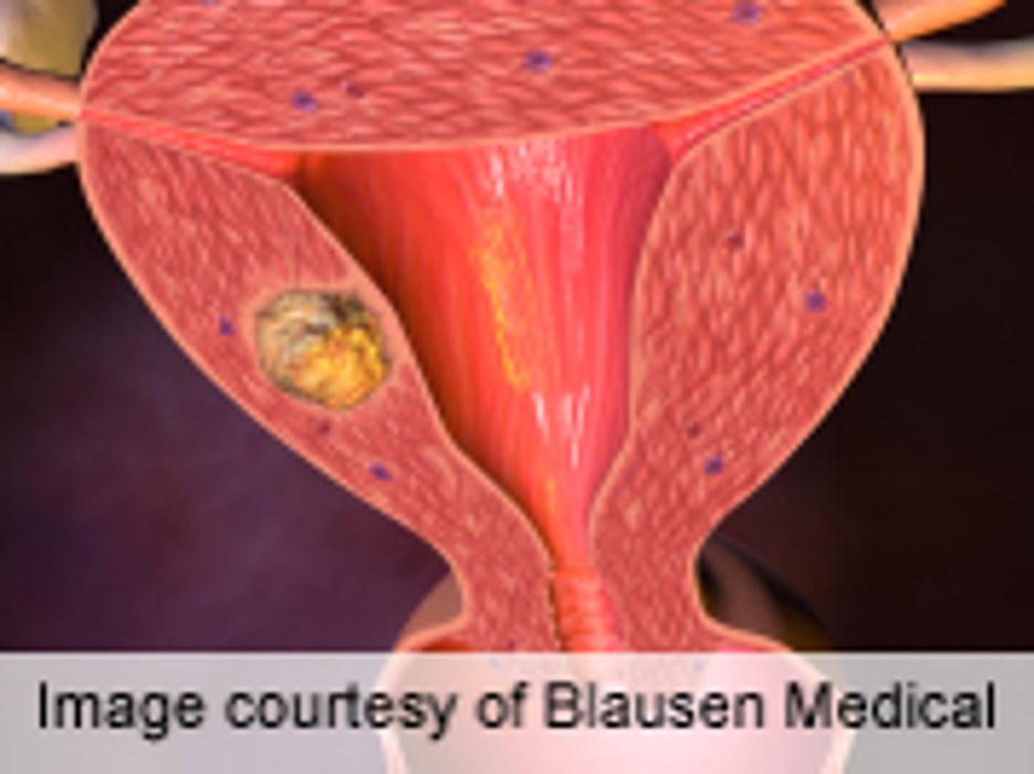 Uterine Cancer in 27/10,000 Women Undergoing Morcellation