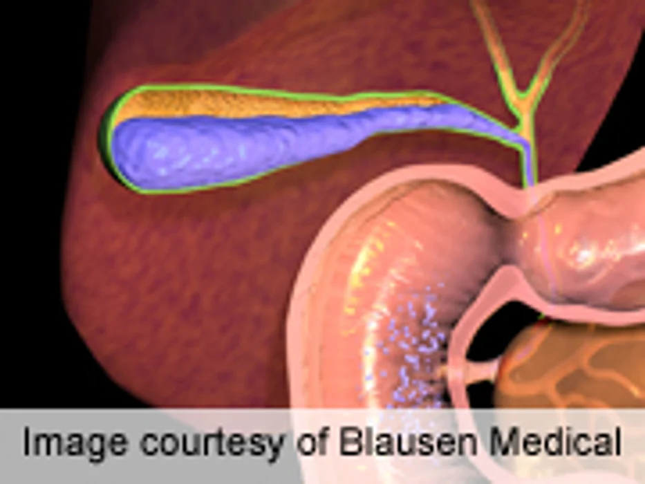 With CD Stone Risk, Shorter Stays w/Cholecystectomy First