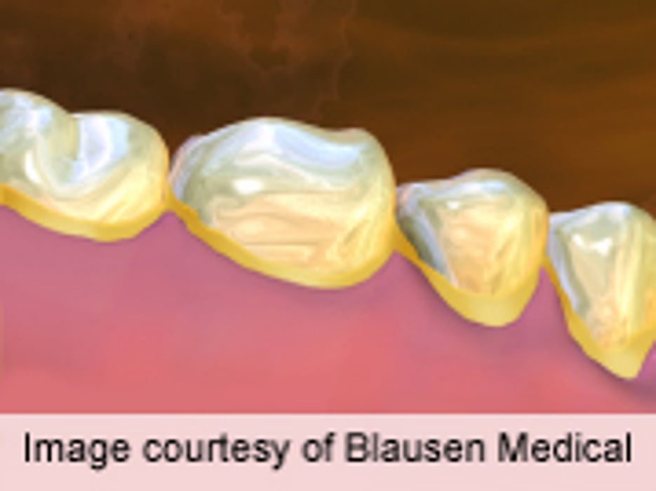 AAP Recommendations Provided for Fluoride Use in Primary Care