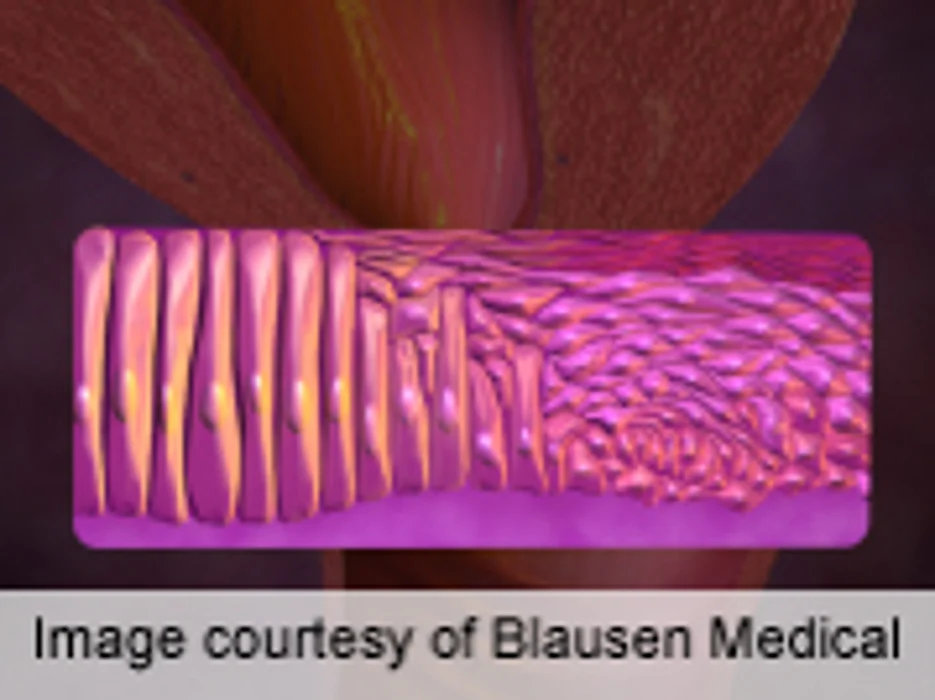 Single Random Biopsy Ups Detection of Cervical Disease