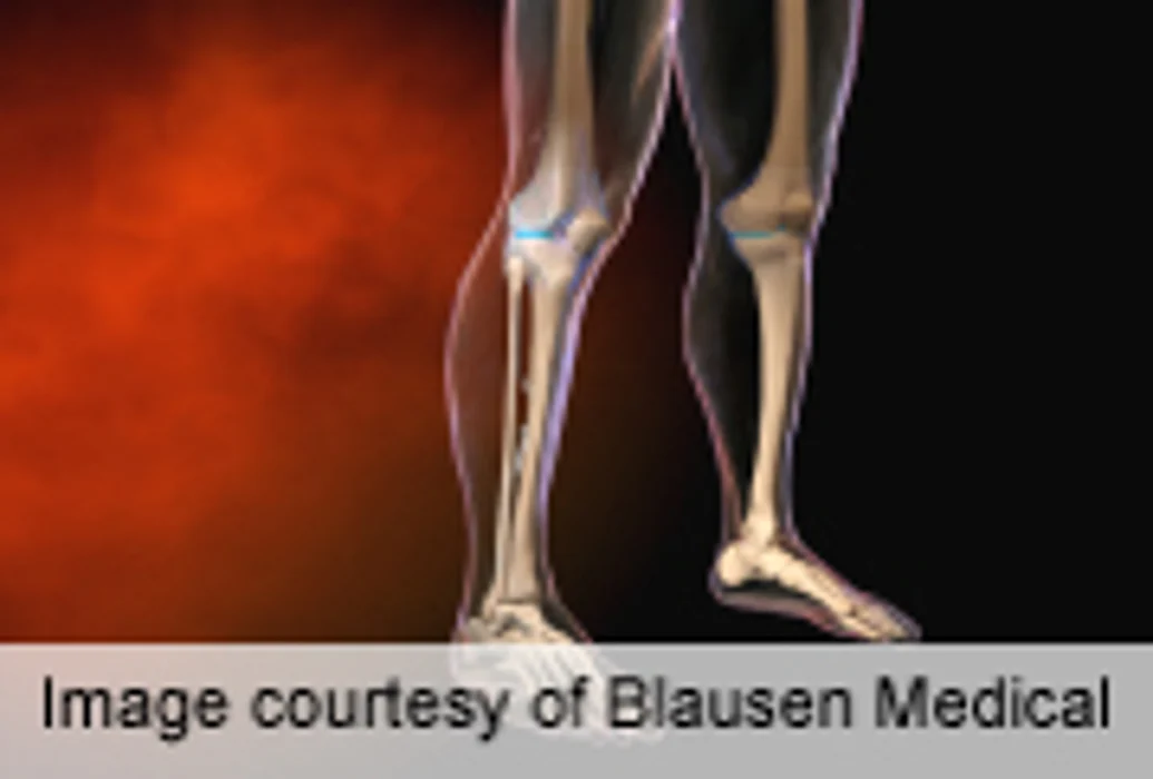 Comparative Studies Lacking for Osteoporosis Drugs