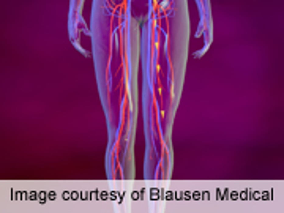 Varicose Vein Treatments All Work, but Aren't Quite Equal