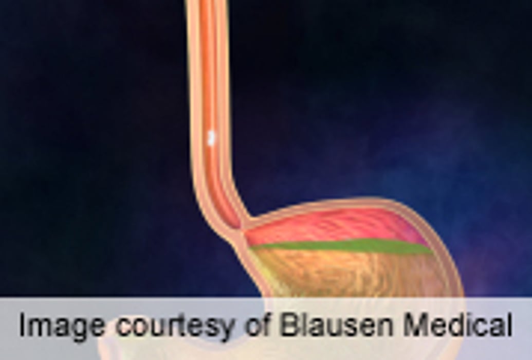 Risk of Upper GI Bleeding Varies for Drug Combinations