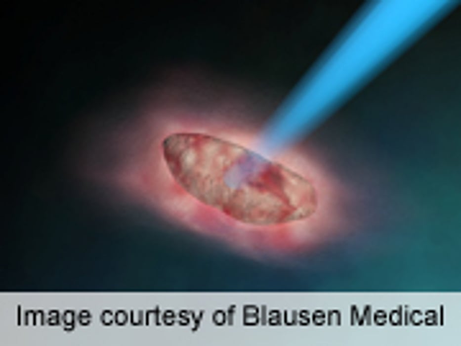 Many Breast Cancer Patients Receive Too Much Radiation Tx