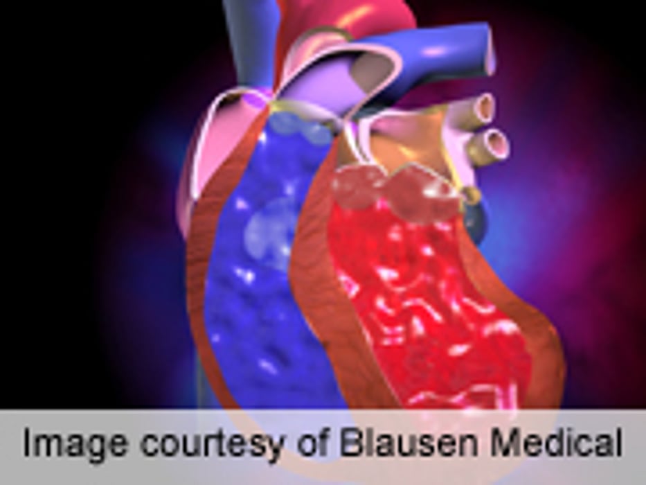 CCC: Causal Link for LDL-C, Aortic Valve Disease