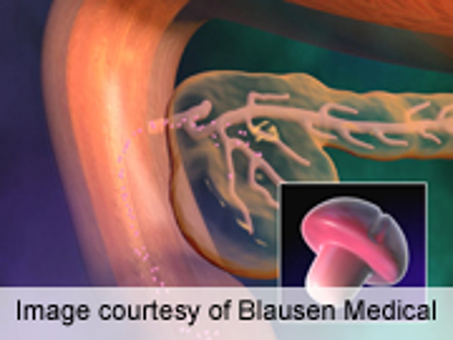 Optimal Screening Cut-Off ID'd for GDM in Twin Pregnancies