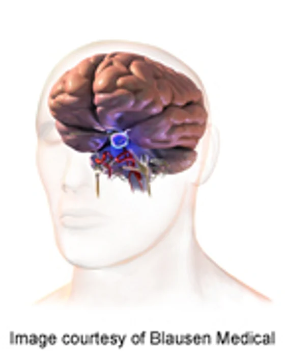 Guideline Developed for Management of Acromegaly