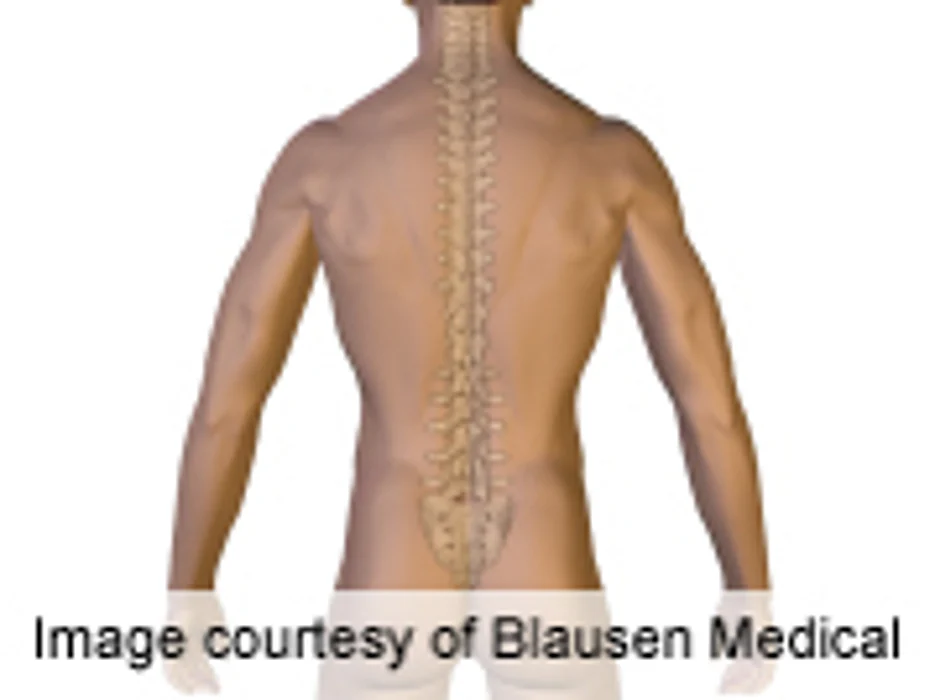 Meds/PT May Work As Well As Surgery for Spinal Stenosis