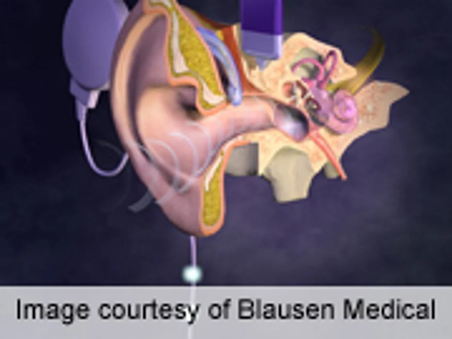 Age Doesn't Affect Outcome of Revision Cochlear Implantation
