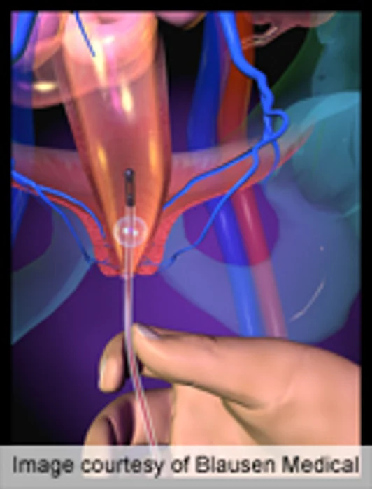 Urinary Catheters Often Left in Too Long During Hospital Stay