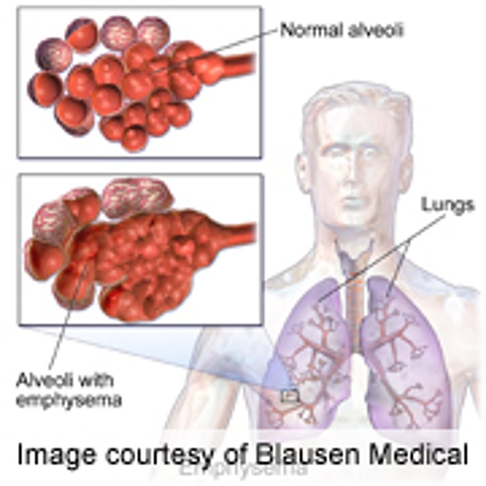 Greater Emphysema-Like Lung on CT Linked to Mortality