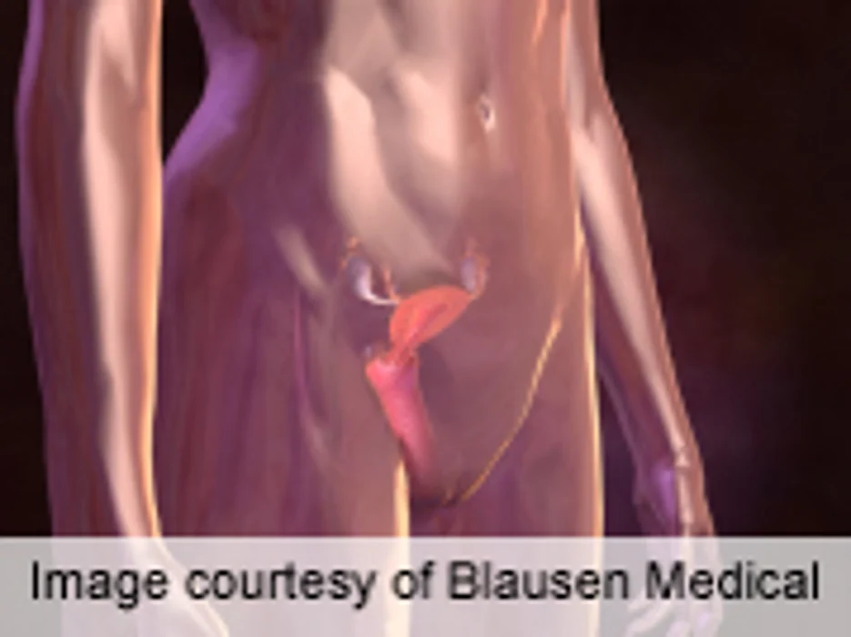 No Increased Risk of Second Cancers With Radiotx in Pelvic CA