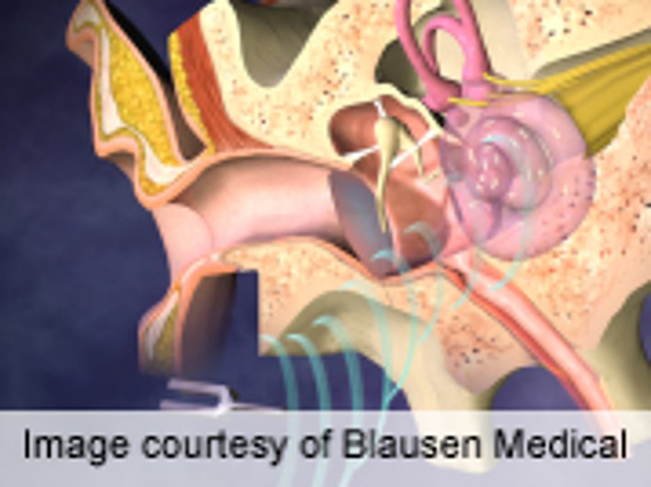 HIV Tied to Hearing Loss Across Frequency Spectrum