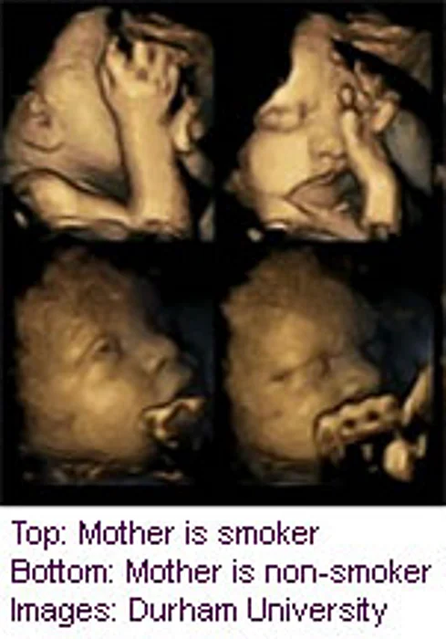 Fetal Faces Seem to React to Mom's Smoking