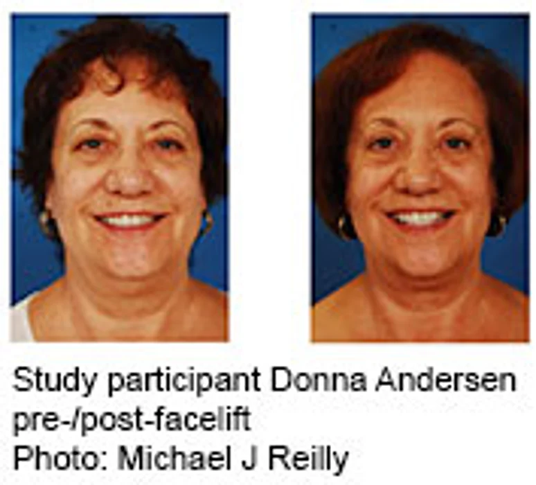 Facelifts May Make Women Seem More Likable, Study Suggests