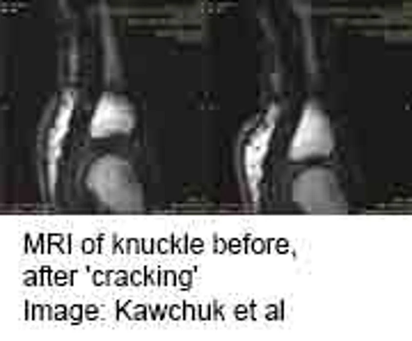 Here's Why Your Knuckles Crack