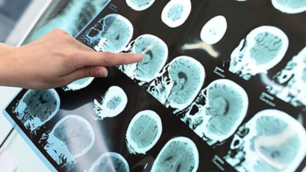 Las lagunas mentales, ¿son un indicio temprano de la enfermedad de Alzheimer?