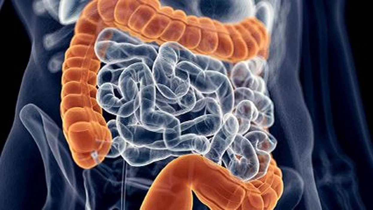 La obesidad y el riesgo de cáncer del colon