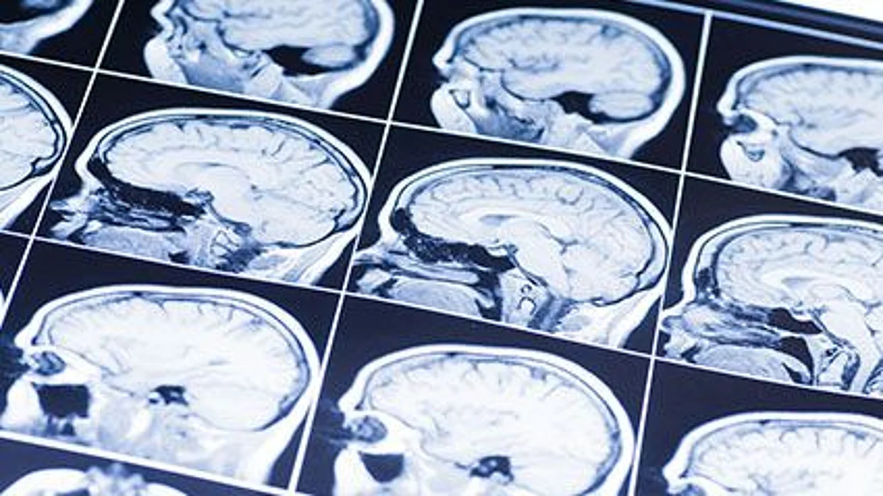 El riesgo de accidente cerebrovascular y el sexo