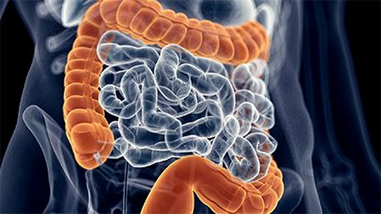 Childhood Obesity and Colon Cancer