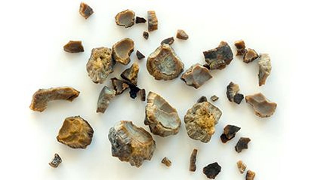 Antibiotics and Kidney Stones Consumer Health News HealthDay
