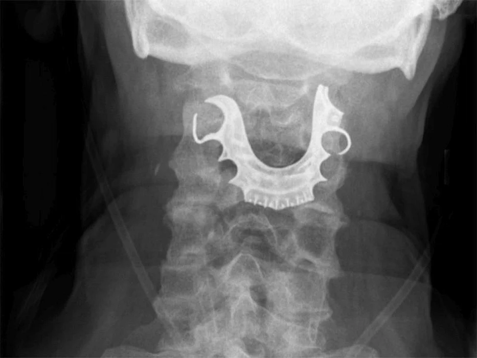 One Man's False Teeth Got 'Lost' in His Throat After Surgery