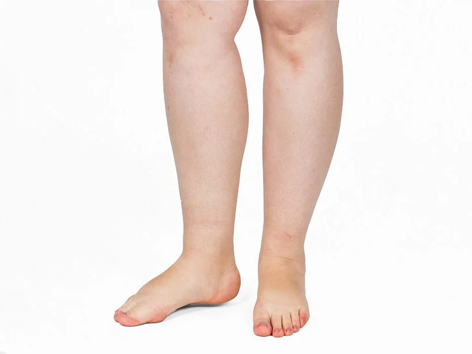 obese legs