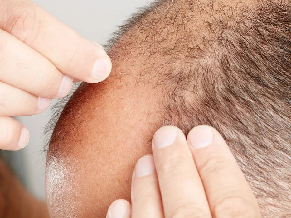 balding man