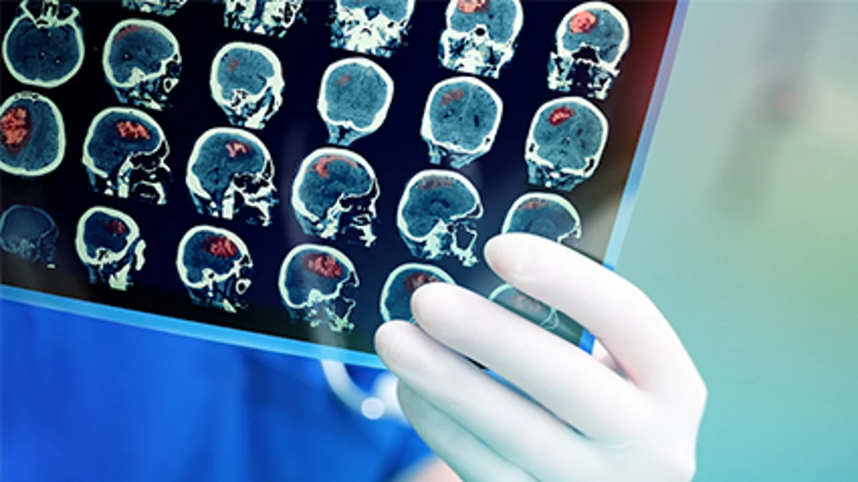 Se reportan cada vez más complicaciones cerebrales graves entre los pacientes con COVID-19, de acuerdo con un estudio nuevo