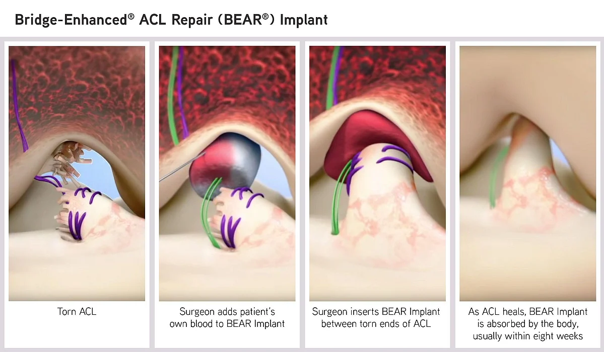 Bridge-Enhanced ACL Repair (BEAR) Implant