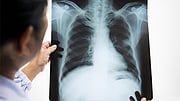 Even Mild Cases Of COVID-19 Can Cause Long-Haul Symptoms