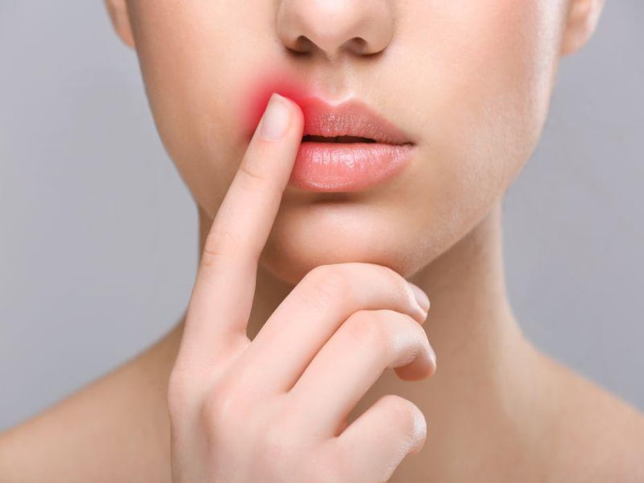 What Causes Herpes Cold Sore Flare-Ups? New Study Offers Clues