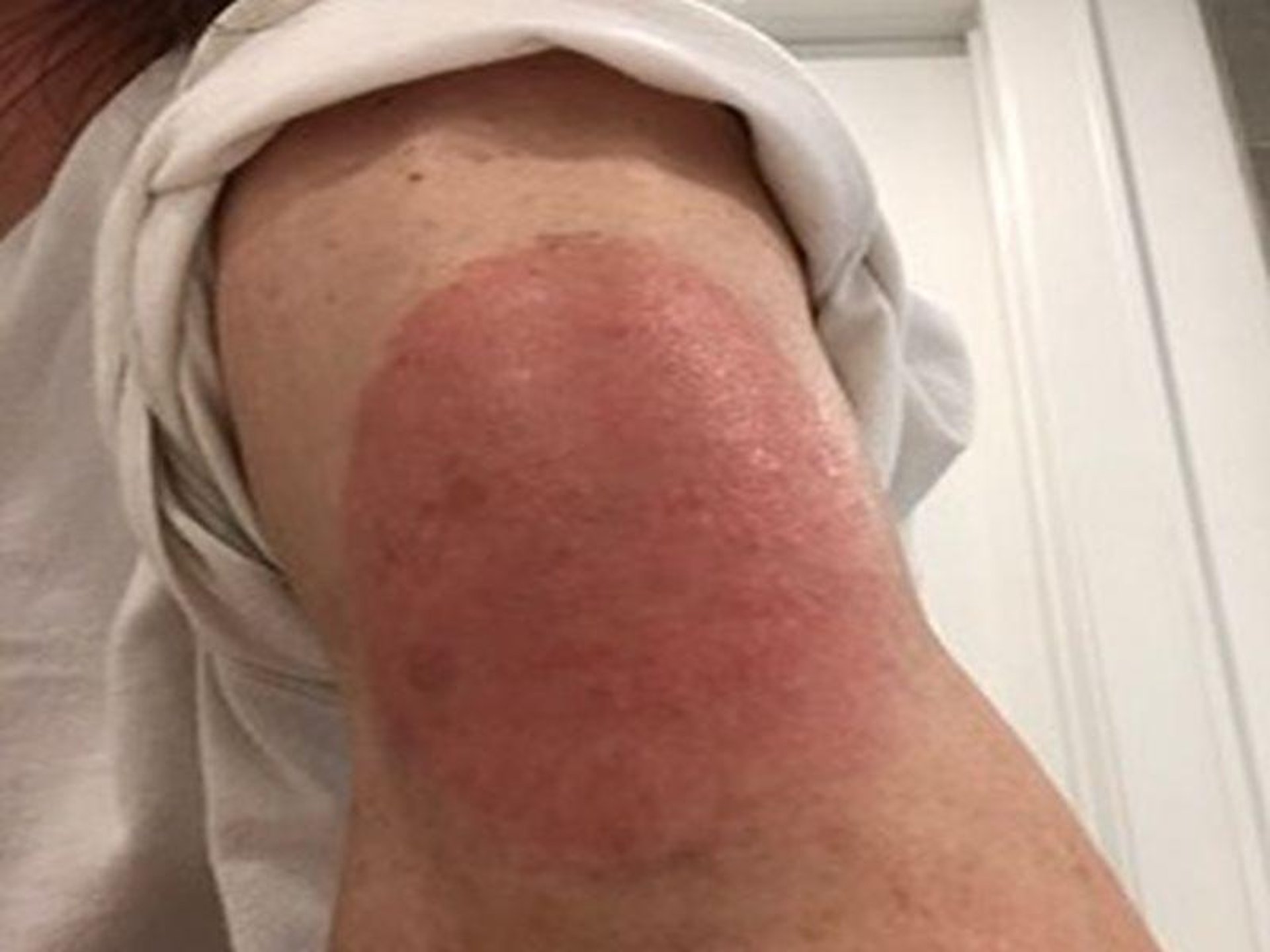 Foto de noticia: Puede haber sarpullido después de la vacuna contra el COVID, pero los dermatólogos dicen 
