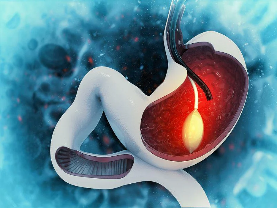 gastric stomach balloon