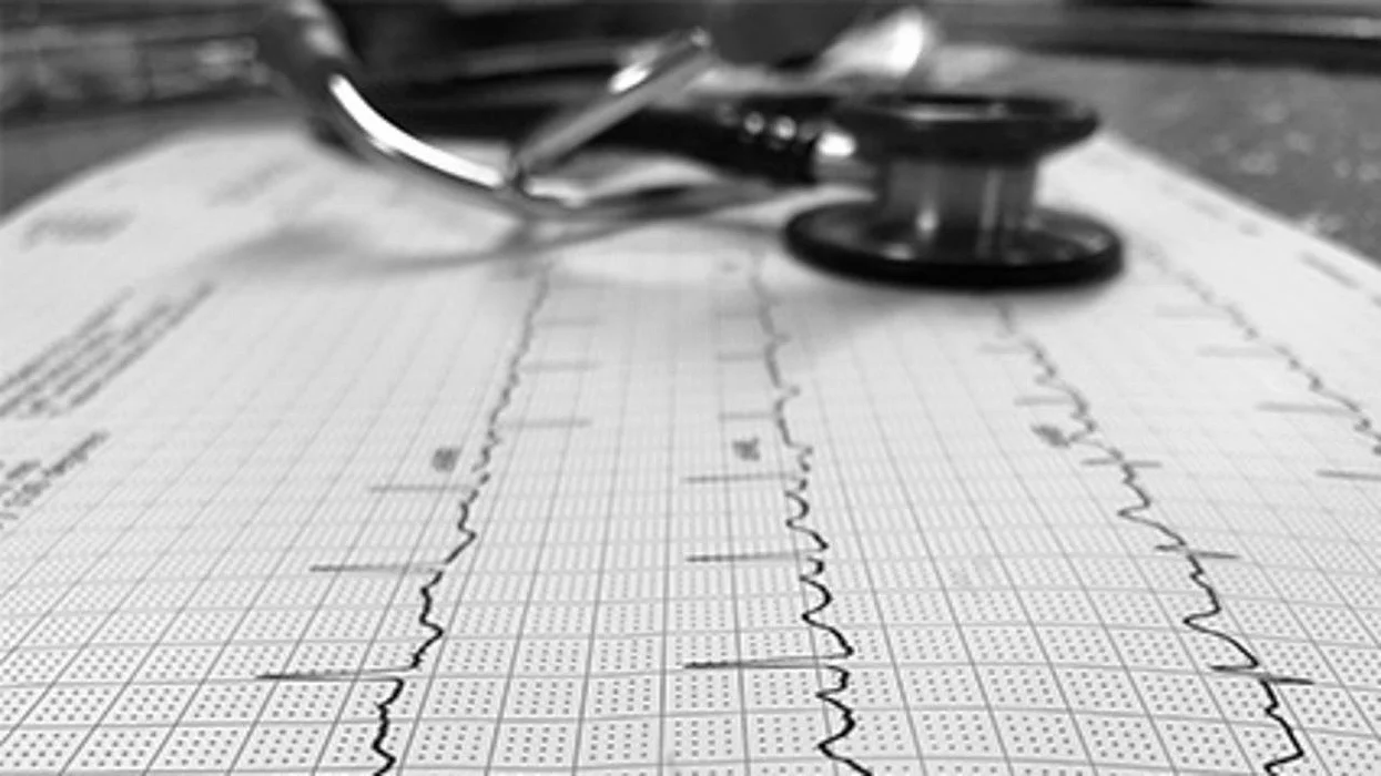 ¿Podría el aceite de pescado aumentar las probabilidades de fibrilación auricular en los pacientes cardíacos?