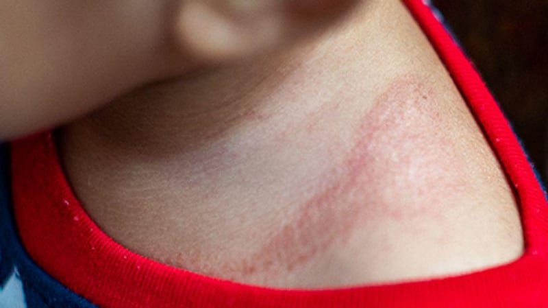 Drug Could Be Promising New Option Against Eczema