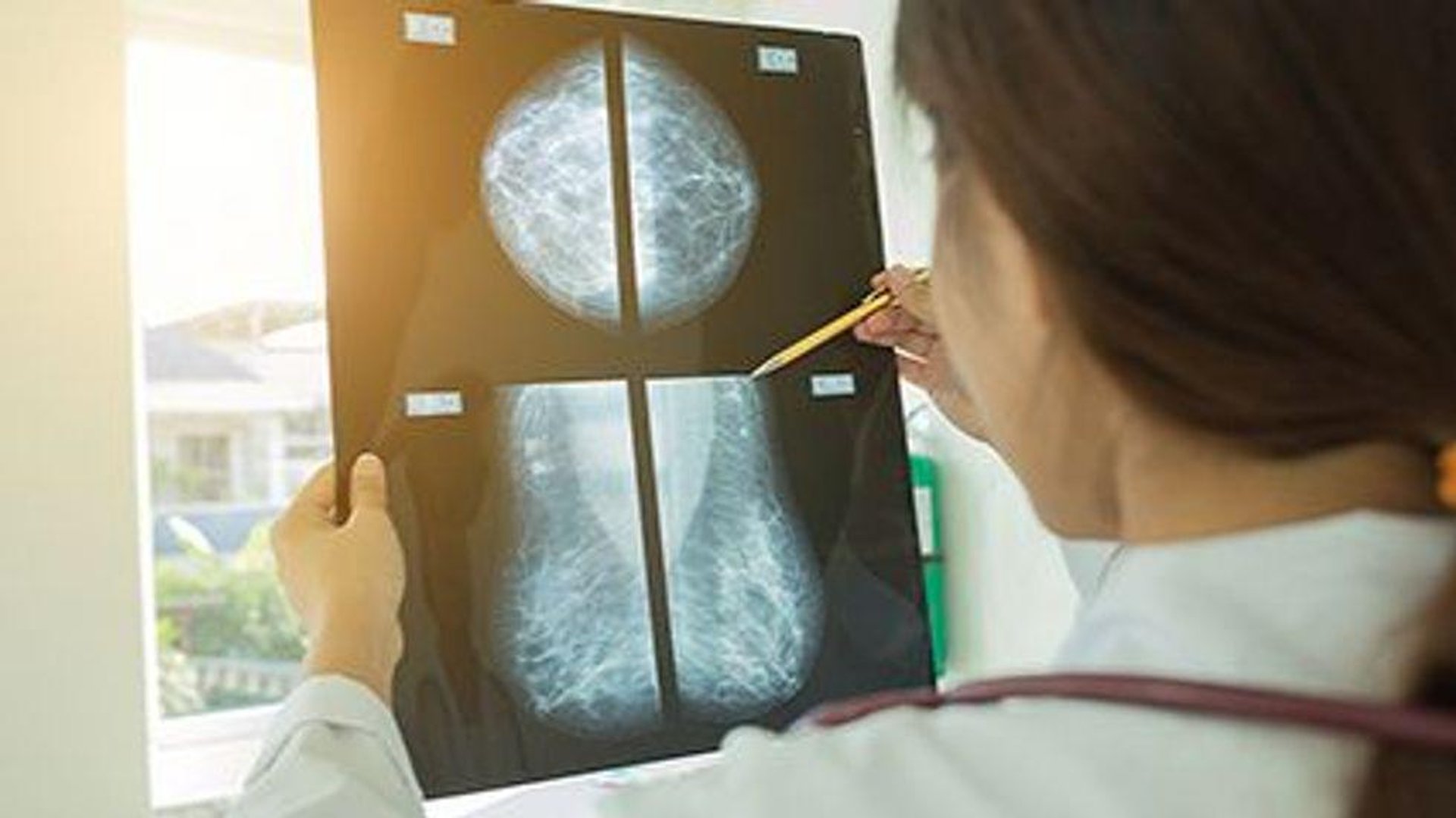 News Picture: Mammography Rates Plummeted During Pandemic