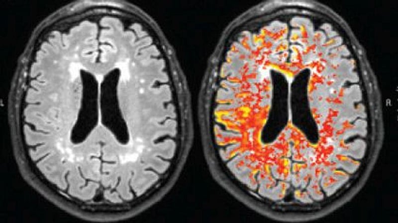 Having OCD May Triple a Person's Odds for a Stroke