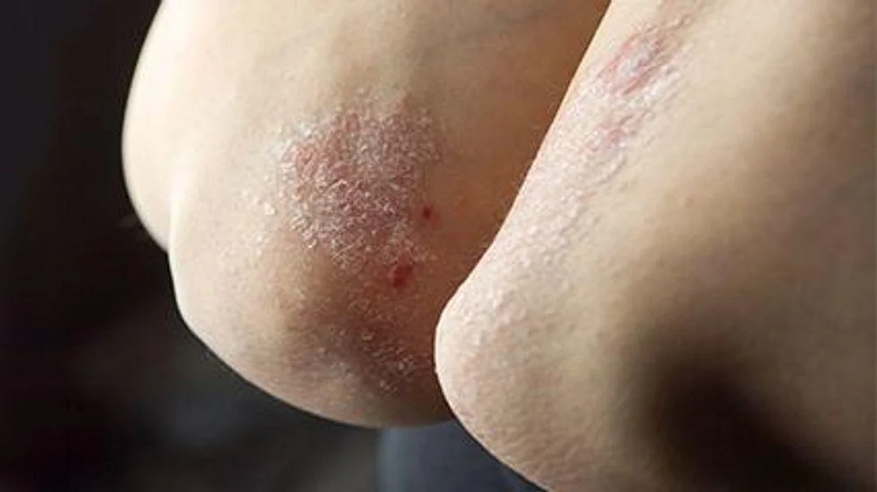 psoriasis