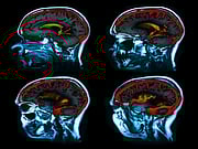 Terapia de estimulação cerebral profunda pode ajudar pacientes com Parkinson a longo prazo