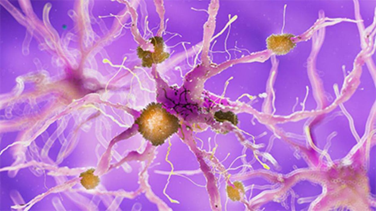 FDA Approves Alzheimer's Drug Despite Expert Panel's Objections