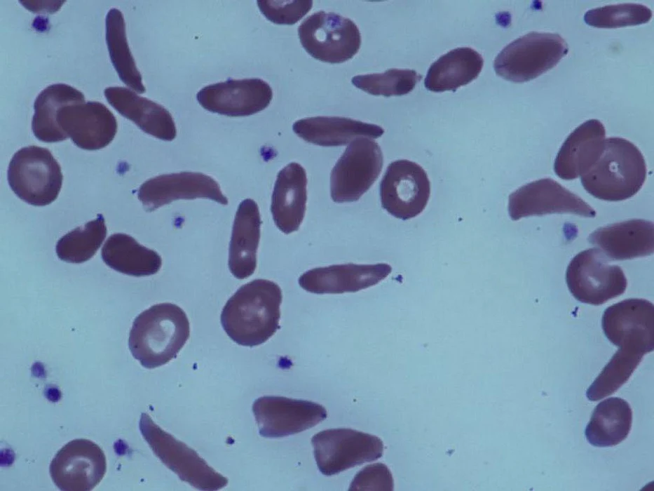 sickle cell anemia