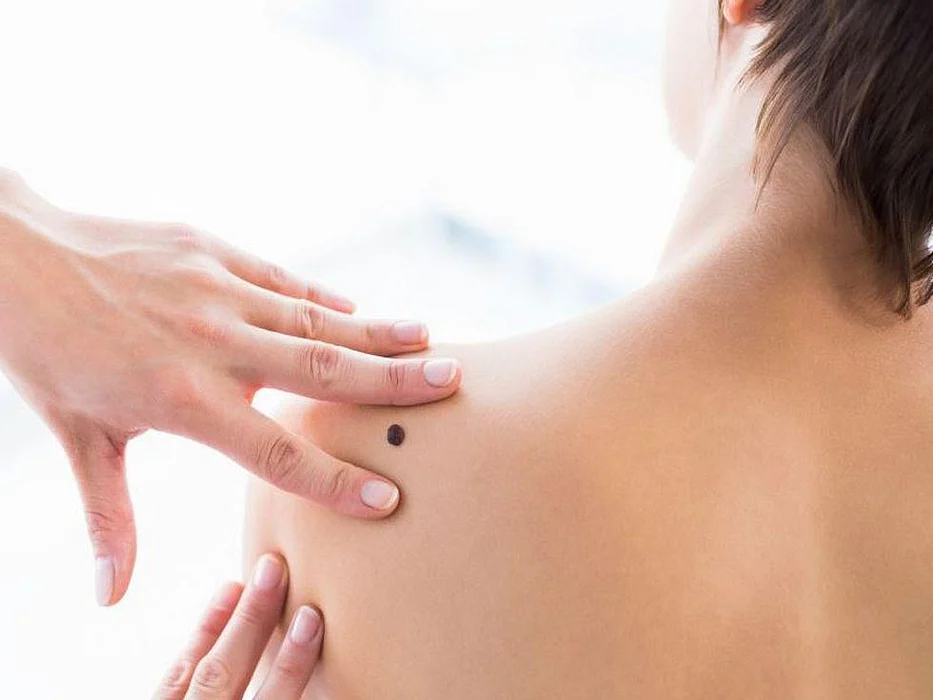 skin cancer exam