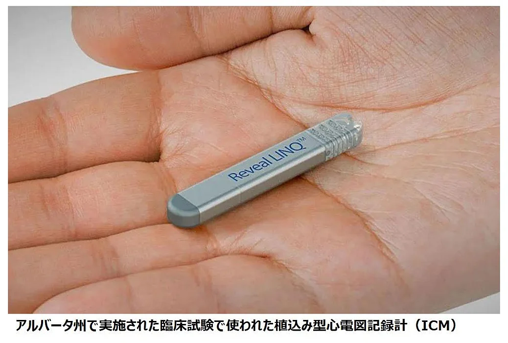 植込み型の心電図記録計で心臓モニタリングの精度が向上