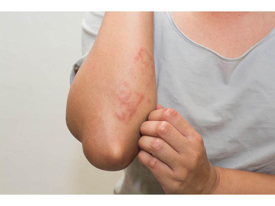 woman showing a rash below her elbow