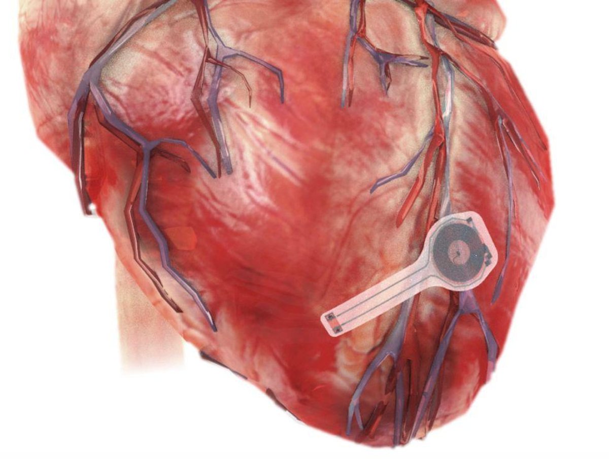  An Implanted Pacemaker That Dissolves Away After Use