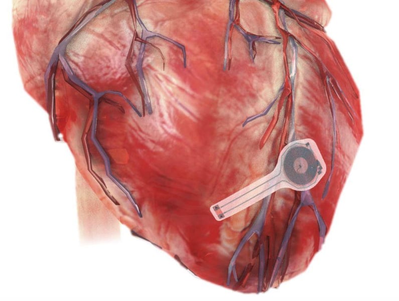 Coming Soon: An Implanted Pacemaker That Dissolves Away After Use