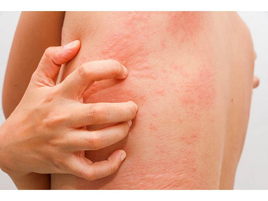 red rash on man's back